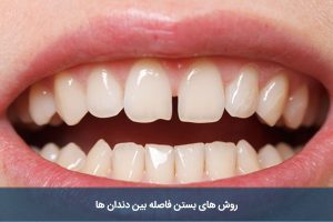 روش های بستن فاصله بین دندان ها