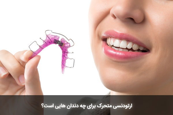ارتودنسی متحرک برای چه دندان هایی است؟