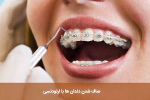 صاف شدن دندان ها با ارتودنسی