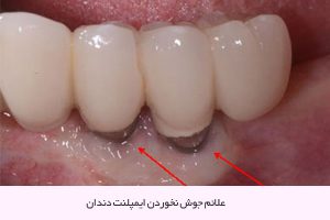 علائم جوش نخوردن ایمپلنت دندان