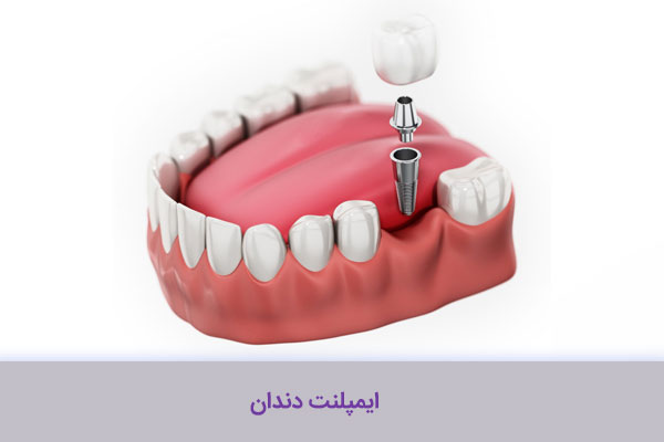 ایمپلنت دندان دکتر سلمی یزدی نژاد