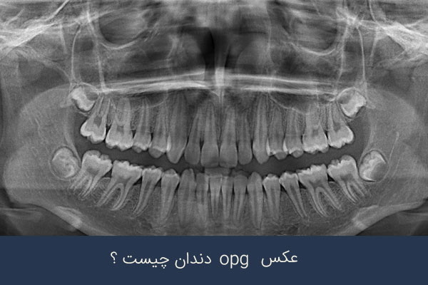 عکس OPG دندان چیست؟